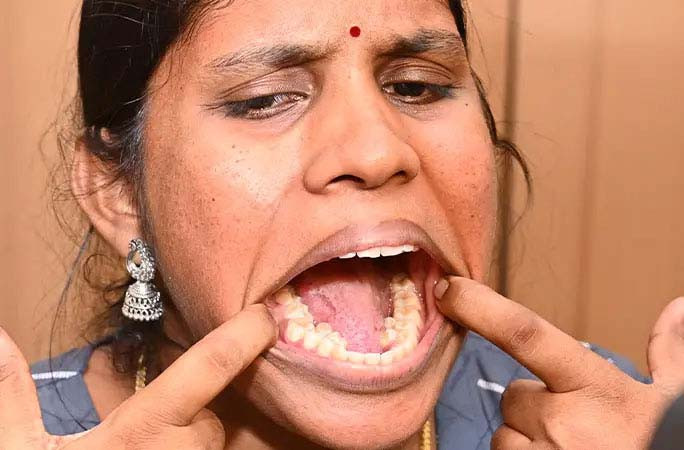 दाँतलाई किरा लाग्न नदिन के गर्ने ?